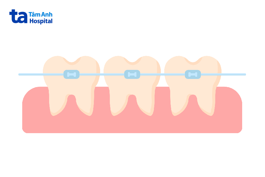 răng lệch khớp cắn