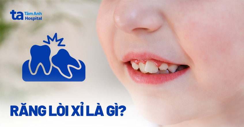 Răng lòi xỉ là gì? Nguyên nhân và cách điều trị hiệu quả