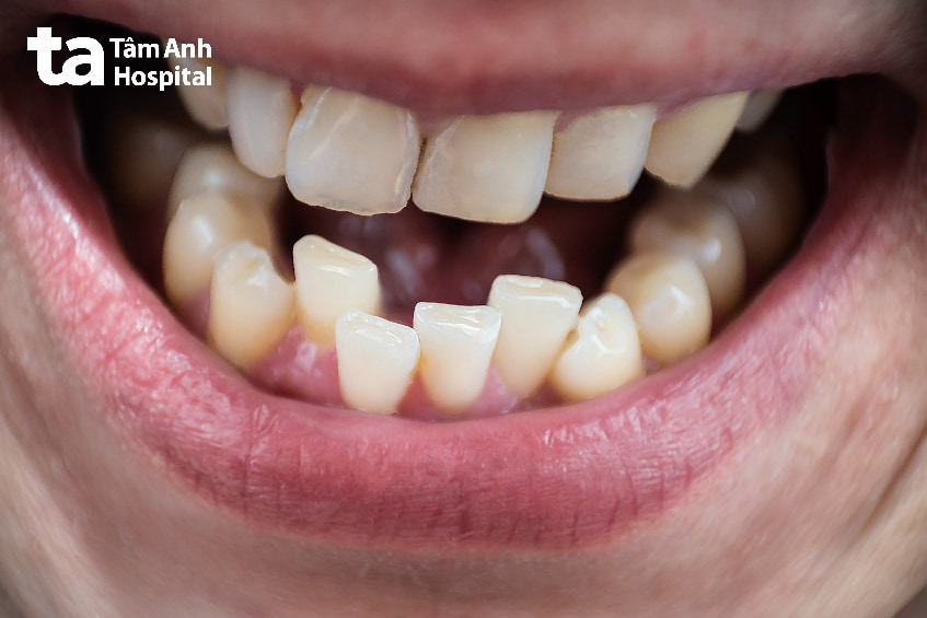 Răng lòi xỉ là gì?