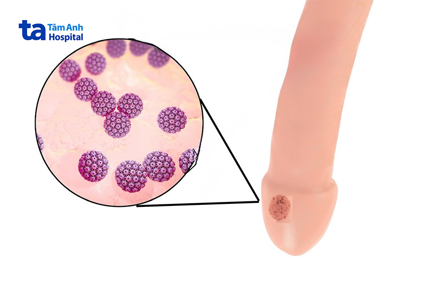 rất dễ lây sang người khác