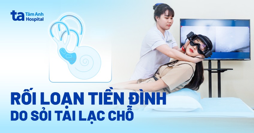 rối loạn tiền đình do sỏi tai lạc chỗ
