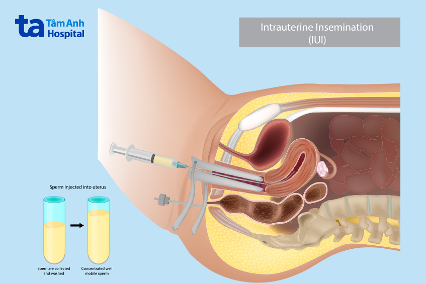 Sau khi thực hiện bơm tinh trùng (IUI), thời gian nghỉ ngơi phụ thuộc vào hướng dẫn của bác sĩ và tình trạng sức khỏe của từng người