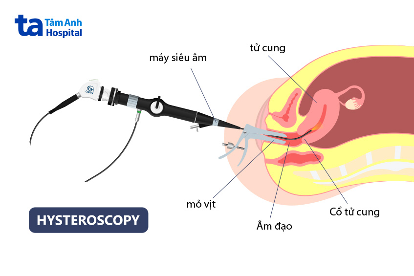 Sau khi siêu âm bơm nước buồng tử cung một số phụ nữ có thể bị ra ít dịch hoặc máu nhẹ sau khi bơm nước