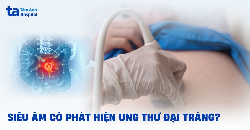 Siêu âm có phát hiện ung thư đại tràng không? Ai cần thực hiện?