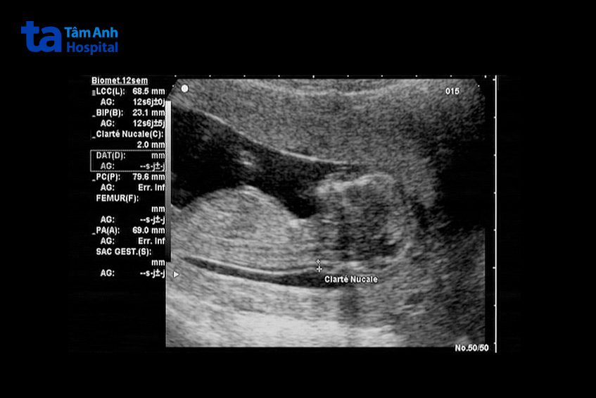 Siêu âm thai IVF tuần 12 giúp kiểm tra sự phát triển toàn diện của bé và đo độ mờ da gáy – xét nghiệm quan trọng sàng lọc nguy cơ dị tật bẩm sinh
