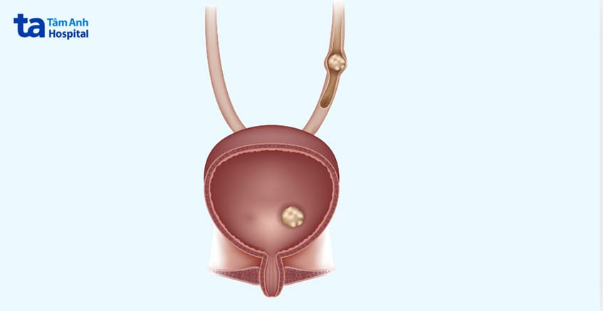 sỏi bàng quang ở nữ có thể do sỏi thận