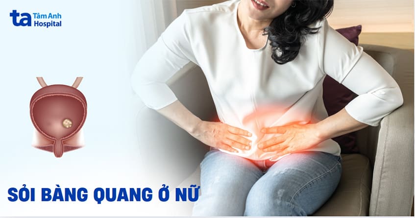 Sỏi bàng quang ở nữ: Nguyên nhân, triệu chứng và điều trị