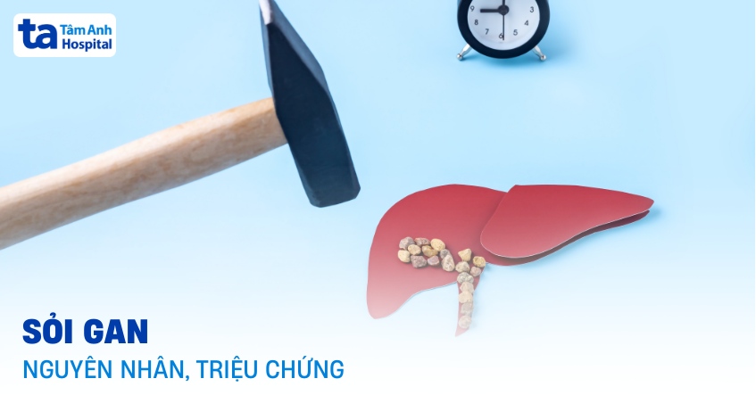 sỏi gan