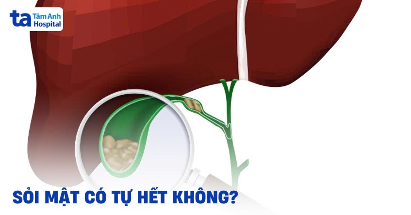 Sỏi mật có tự hết không? Giải đáp chi tiết từ chuyên gia
