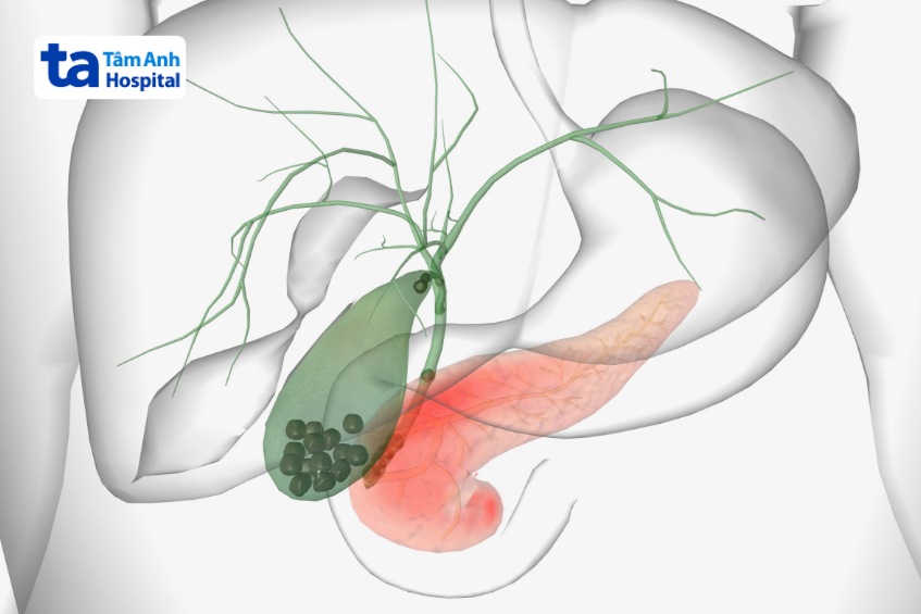 sỏi mật có tự khỏi không