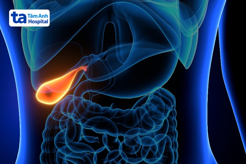 sỏi mật hình thành do nhiều nguyên nhân