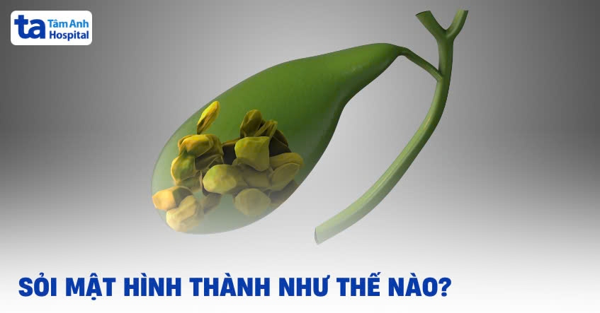 Sỏi mật hình thành như thế nào? Nguyên nhân và cơ chế chi tiết
