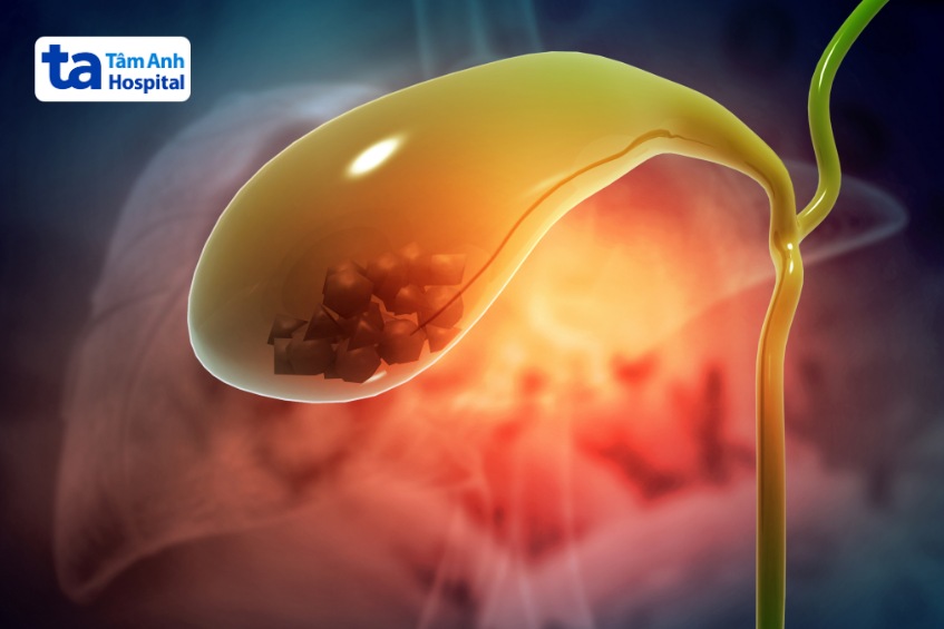 sỏi mật tự khỏi không