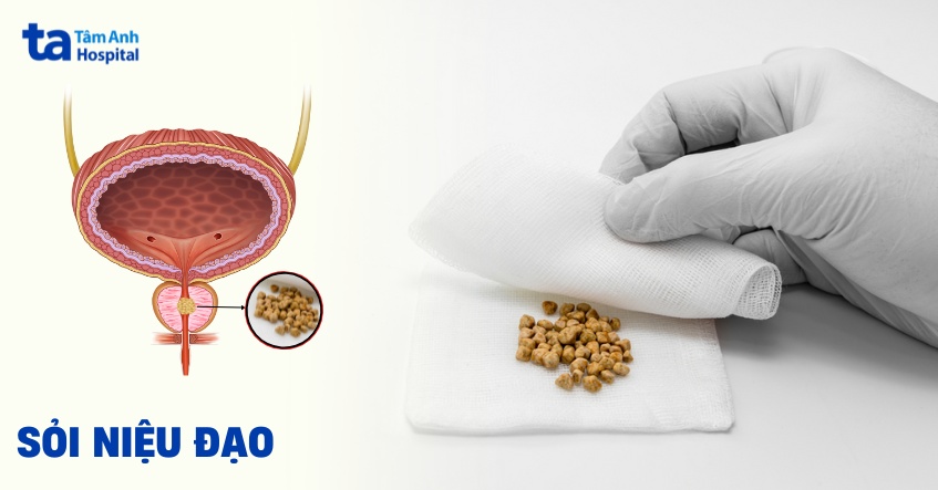 Sỏi niệu đạo: Nguyên nhân, triệu chứng, chẩn đoán, phòng ngừa