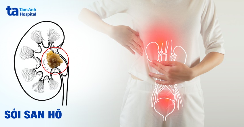 Sỏi san hô: Nguyên nhân, triệu chứng và cách điều trị dứt điểm