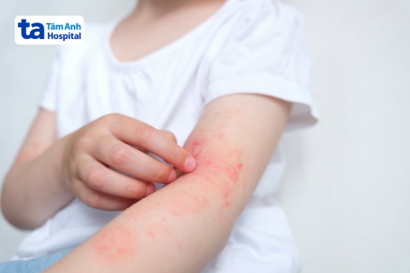 không cho trẻ chạm vào vùng ngứa