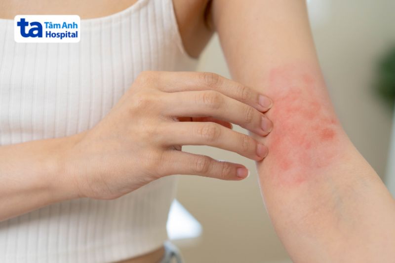 sốt ban đỏ ở người lớn