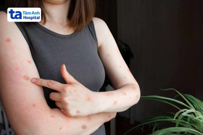 triệu chứng sốt phát ban ở người lớn