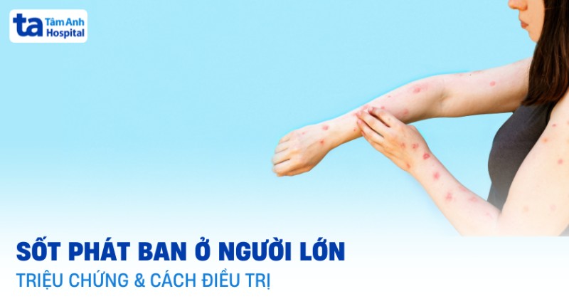Sốt phát ban ở người lớn: Triệu chứng, nguyên nhân, điều trị