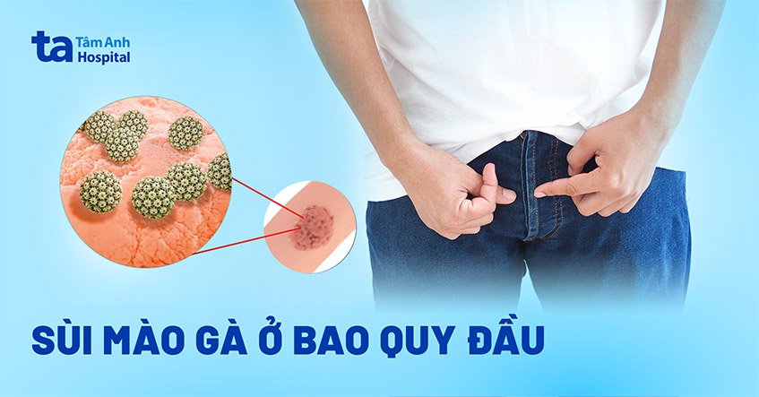 Bệnh sùi mào gà ở bao quy đầu: Nguyên nhân và triệu chứng