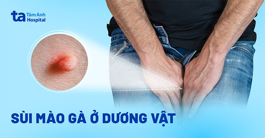 Sùi mào gà ở dương vật: Nguyên nhân, dấu hiệu, chẩn đoán, phòng ngừa