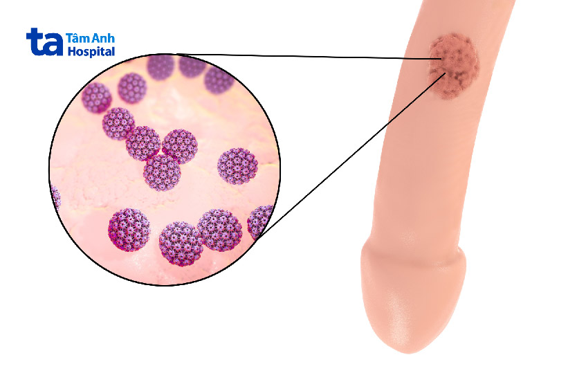 sui-mao-ga-o-quy-dau