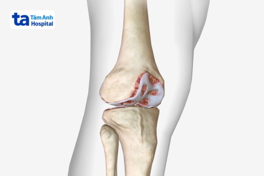 Sụn khớp hấp thu glucosamine