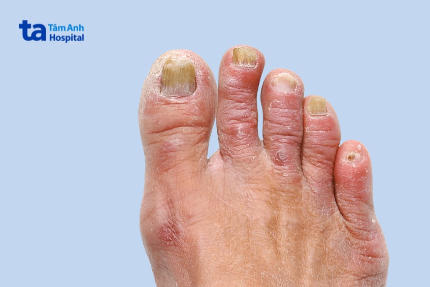 tác hại của nấm kẽ móng chân