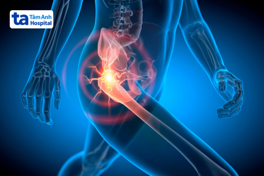 Tại sao viêm khớp háng cần quan tâm chế độ dinh dưỡng