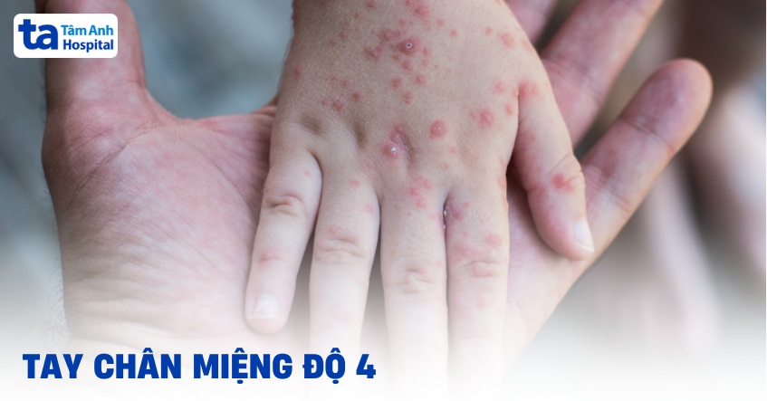 Tay chân miệng độ 4: Nguyên nhân, triệu chứng và cách điều trị