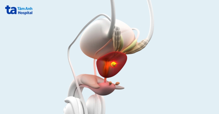 tế bào ung thư tuyến tiền liệt cần phẫu thuật cắt bỏ