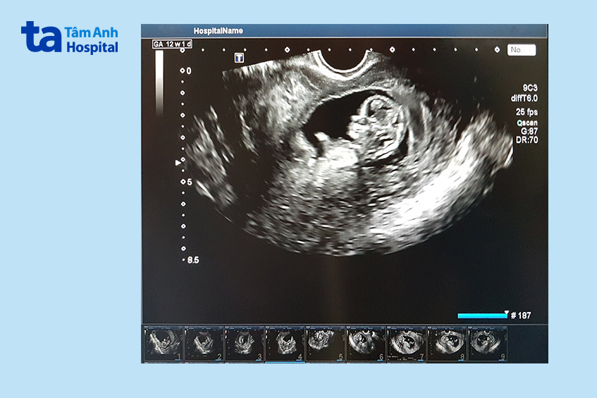 Thai IVF 12 tuần đang bước vào giai đoạn phát triển nhanh về hệ thần kinh, xương, não và các giác quan
