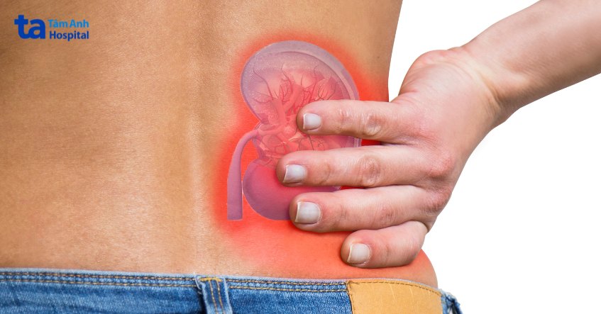 thận ứ mủ luôn liên quan đến sự hiện diện của cả thận ứ nước