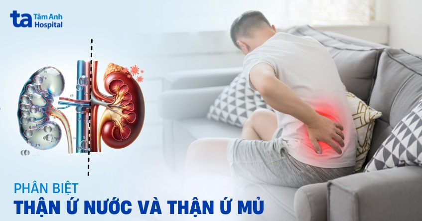 Cách phân biệt thận ứ nước và ứ mủ chi tiết dễ hiểu