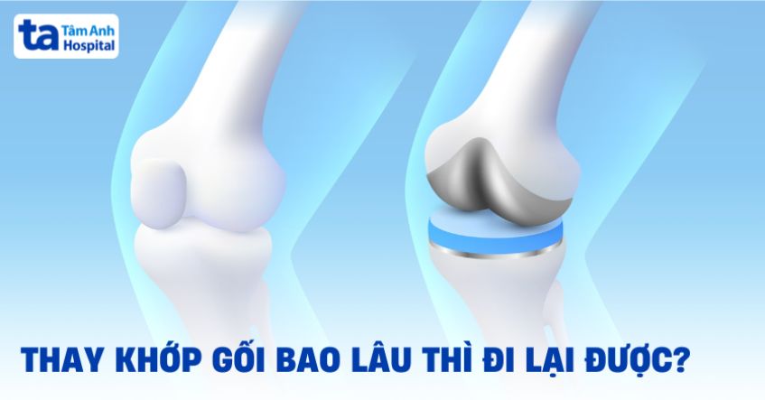 Thay khớp gối bao lâu thì đi lại được bình thường? Cần lưu ý gì?