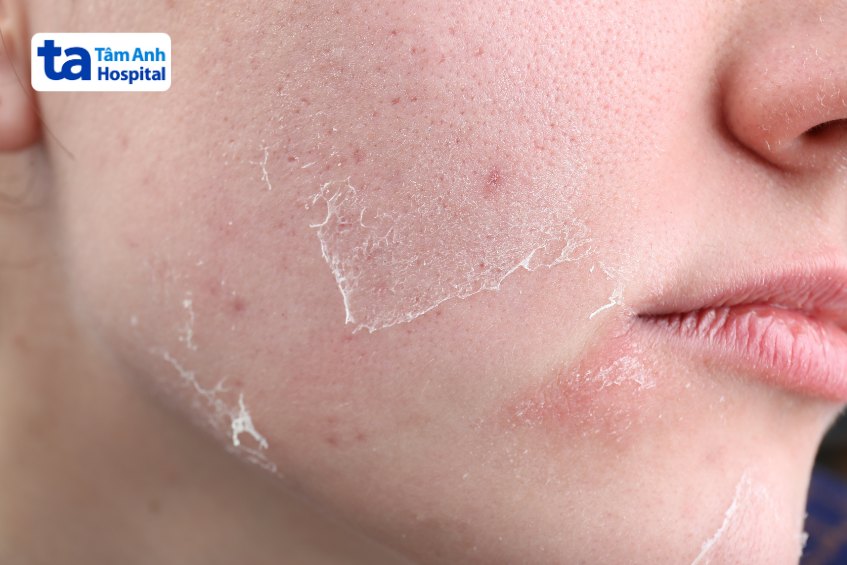 thời gian hồi phục sau khi chấm tca