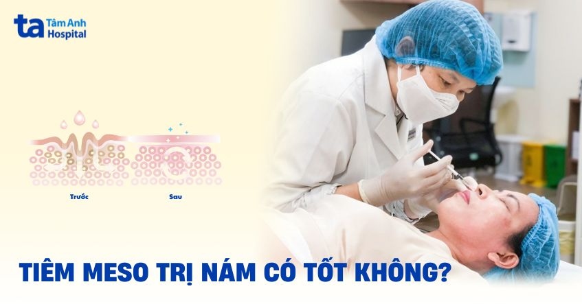 tiêm meso trị nám có tốt không