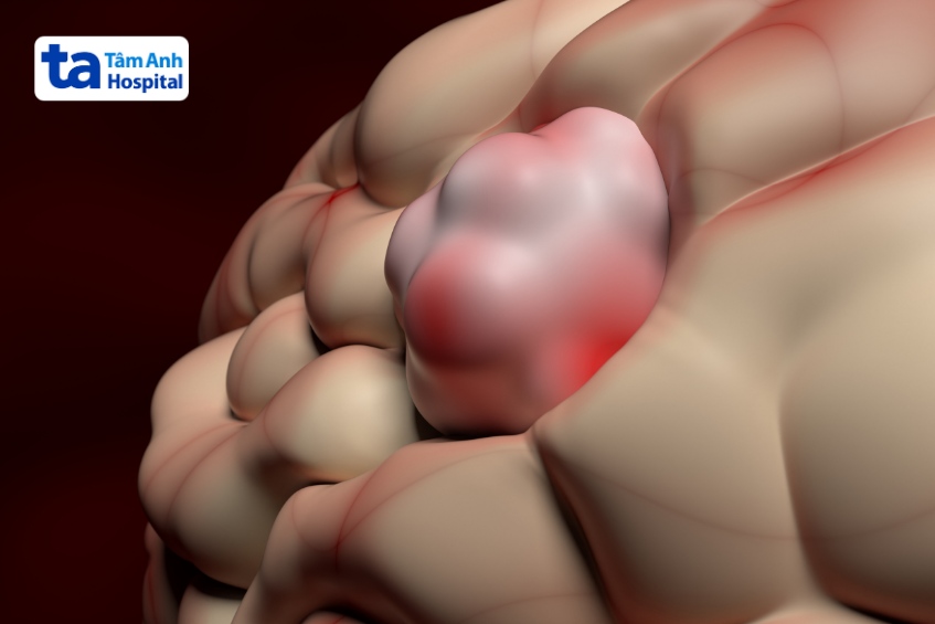 tiên lượng các loại u não lành tính khác nhau