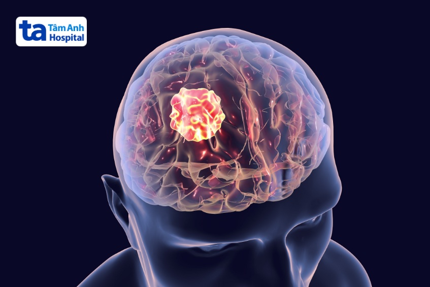 tiên lượng các loại u não lành tình phụ thuộc nhiều yếu tố