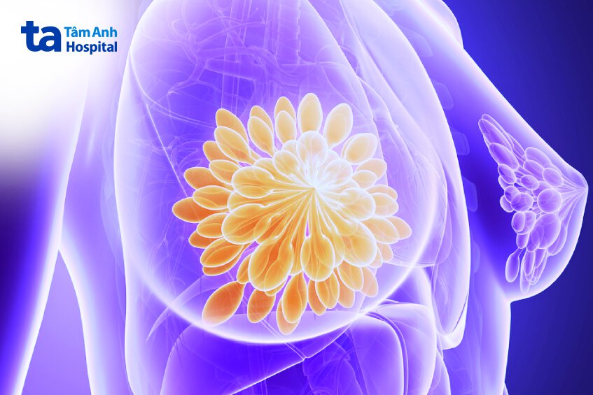 tiên lượng sống ung thư vú giai đoạn 2