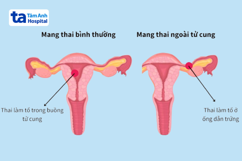 Tiền sử thai ngoài tử cung có thể ảnh hưởng đến khả năng làm mẹ trong tương lai của phụ nữ
