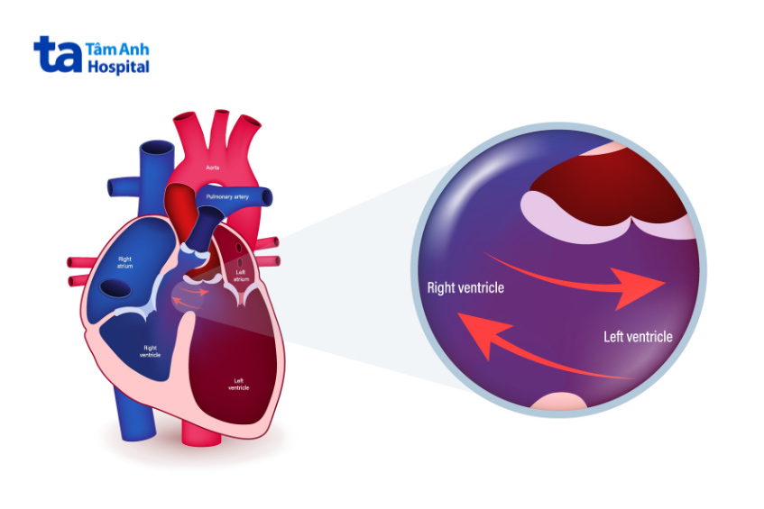 Trái tim bị tứ chứng Fallot