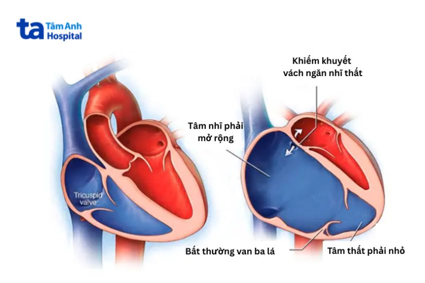 Hình ảnh trái tim bình thường và trái tim mắc dị tật Ebstein