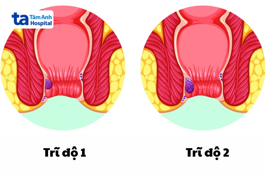 trĩ cấp độ 2 có nguy hiểm không