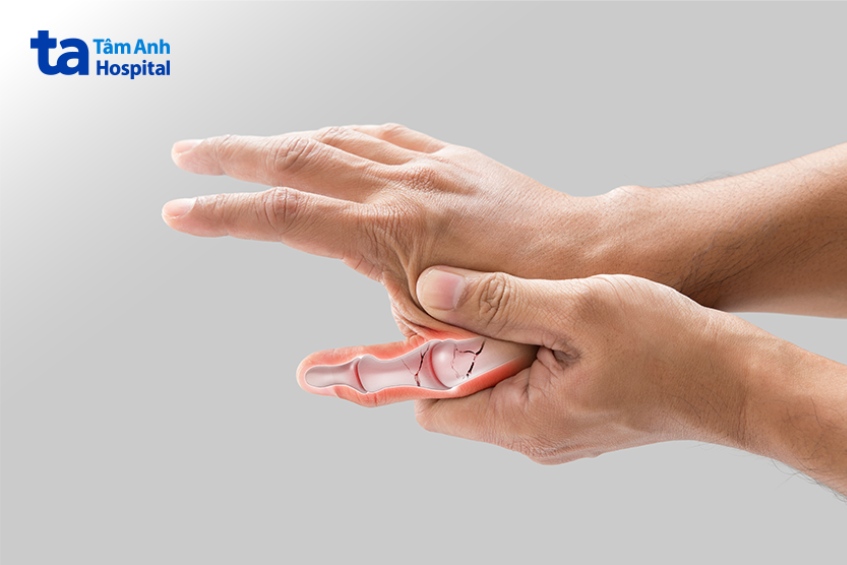Triệu chứng cứng khớp ngón tay cái thường gặp