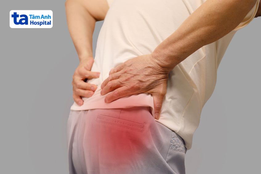 Triệu chứng đau thần kinh tọa do thoát vị đĩa đệm