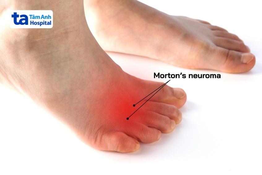 triệu chứng đau u dây thần kinh morton