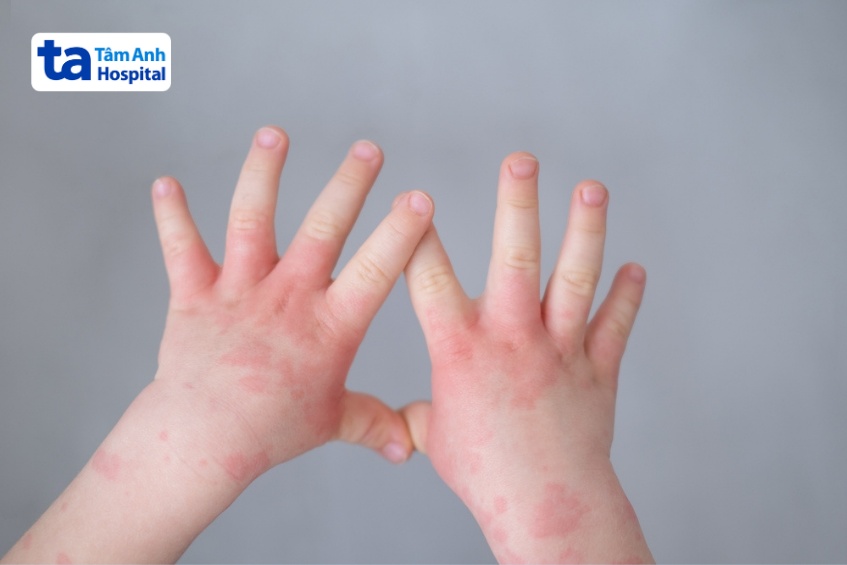 triệu chứng phổ biến khi bị dị ứng thức ăn