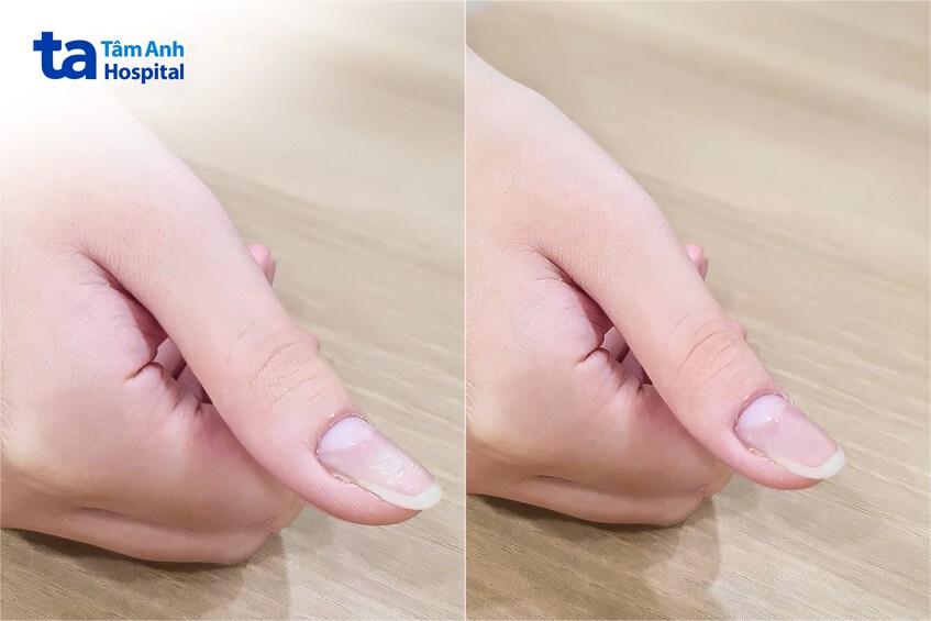 trước và sau điều trị