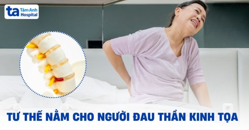 3 tư thế nằm cho người đau thần kinh tọa giúp cải thiện bệnh